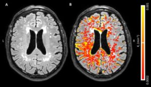 leaky-brain-alzheimers